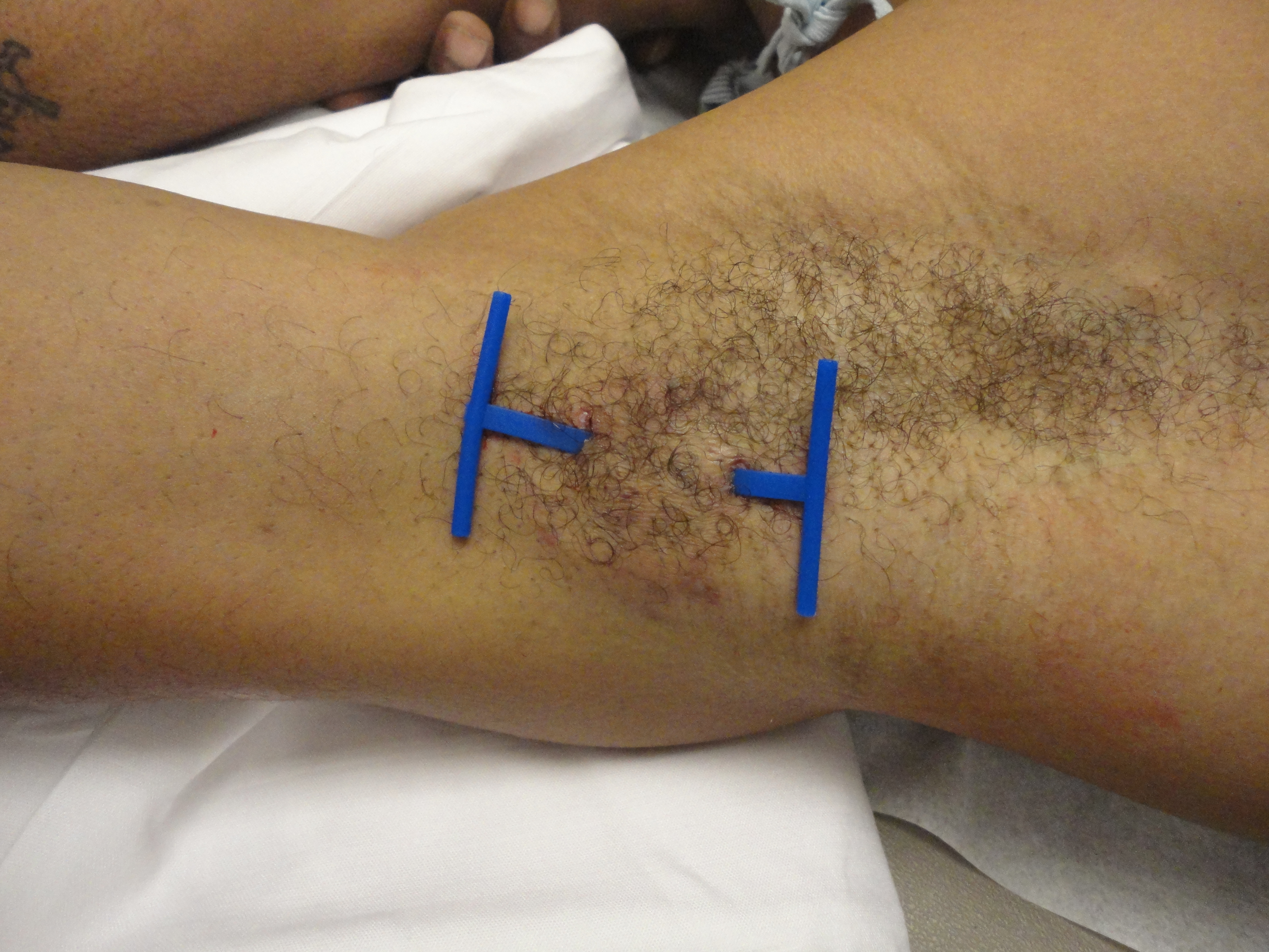 The Derma-Stent was applied to an abscess located in the patient's armpit.