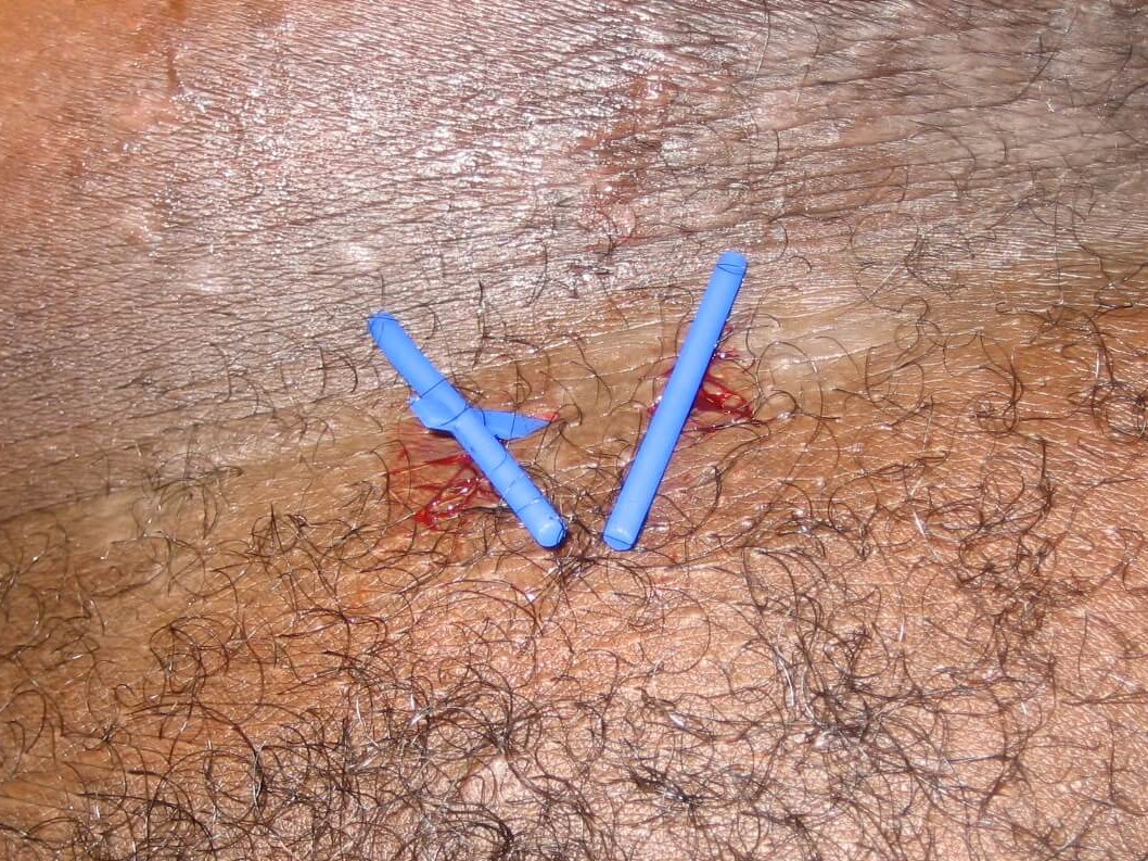 Double incision in an abscess.
