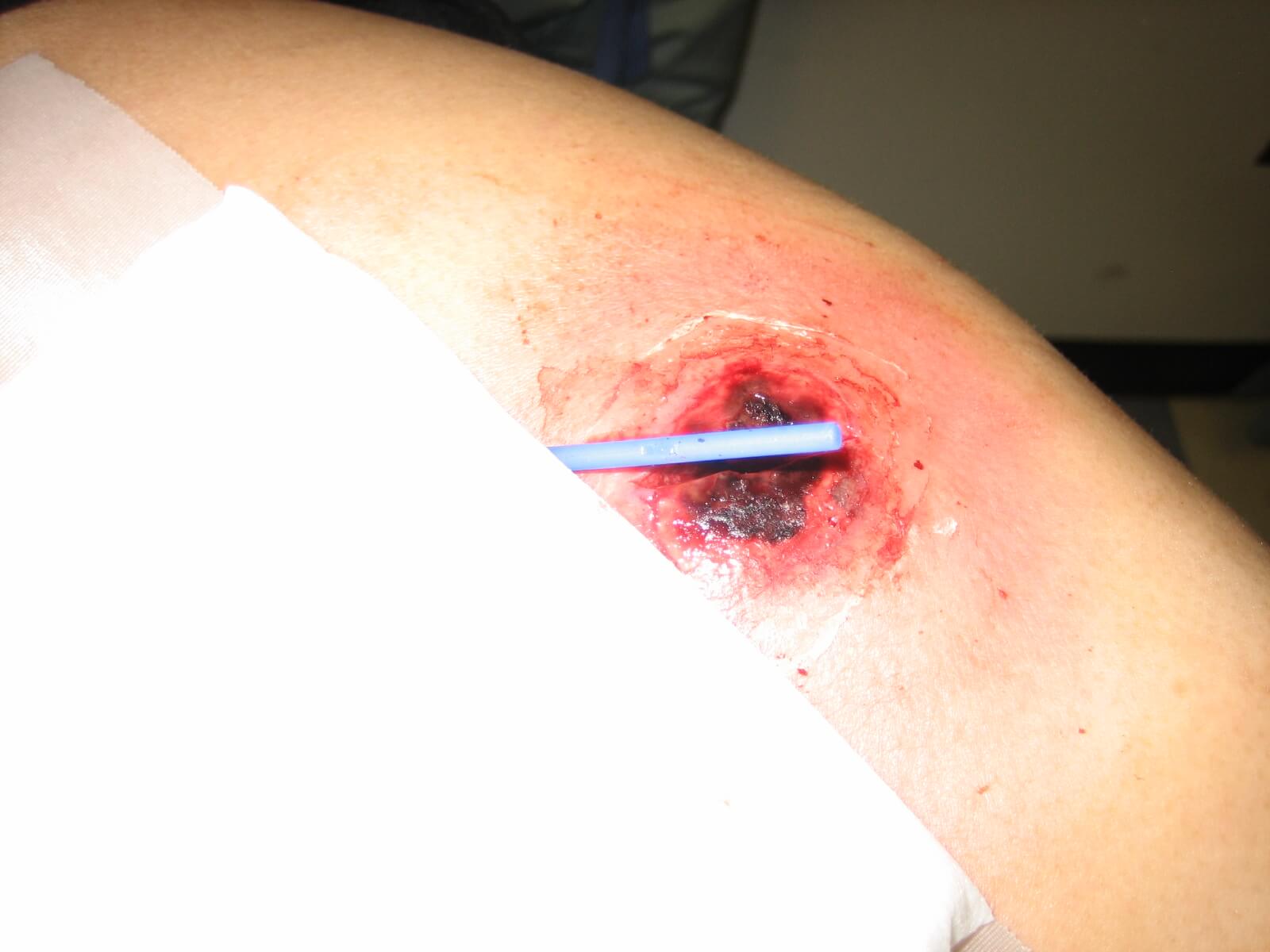 Derma-Stent being used with one incision on the abscess.