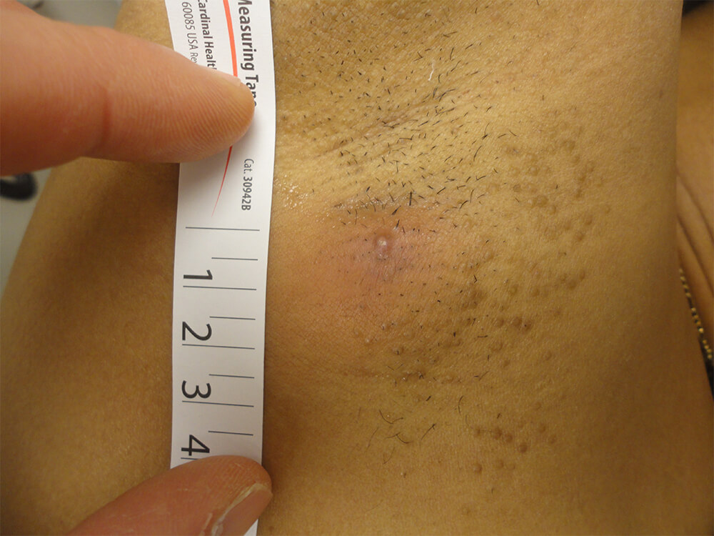 Derma-Stent scarring shown after treatment.