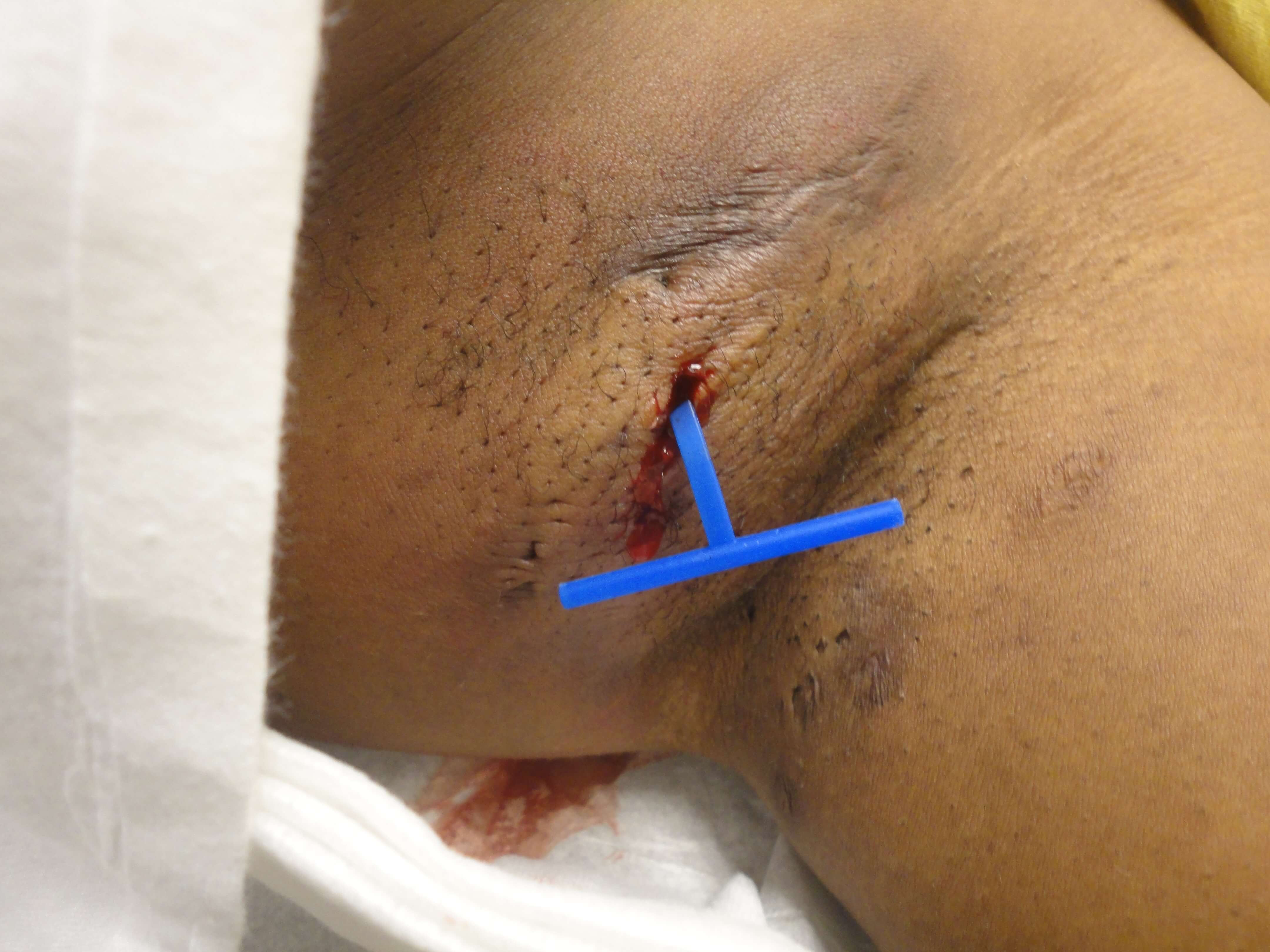 Derma-Stent being used with one incision on the abscess.