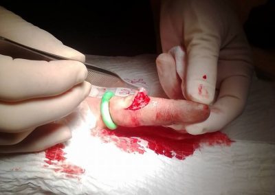 Large Tourni-Cot | Digit Tourniquet | Finger Laceration Injury | Emergency Medicine | Medical Device | Mar-Med